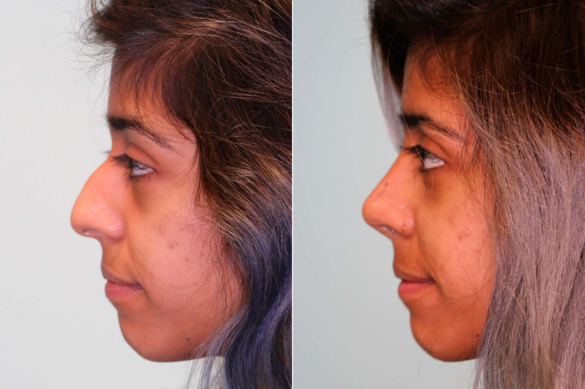 Before and after Rhinoplasty by Dr. Shervin Naderi, Patient 19199