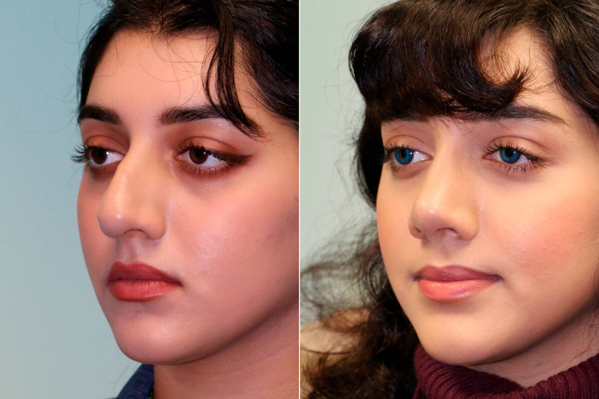 Before and after Rhinoplasty by Dr. Shervin Naderi, Patient 19236