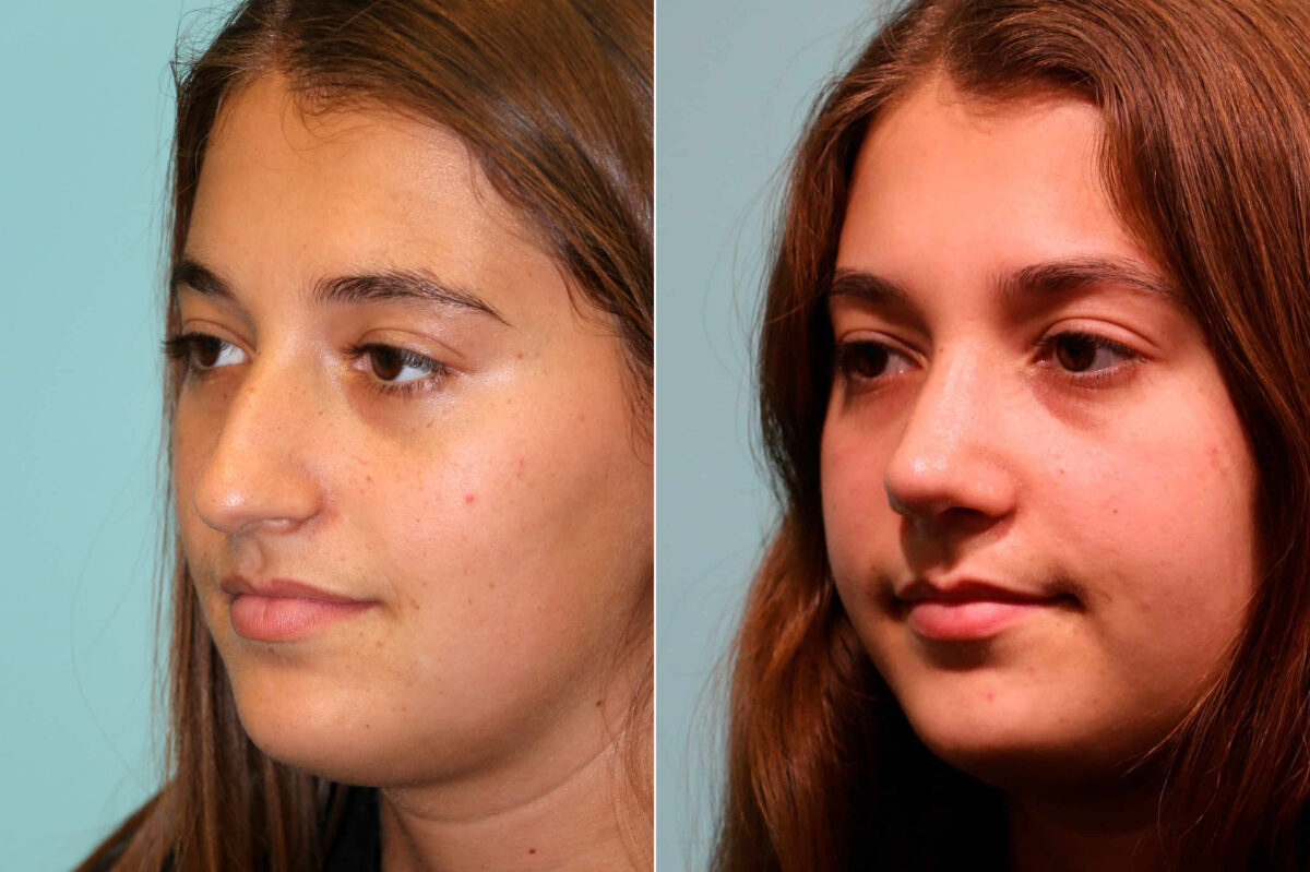 Before and after Rhinoplasty by Dr. Shervin Naderi, Patient 19253