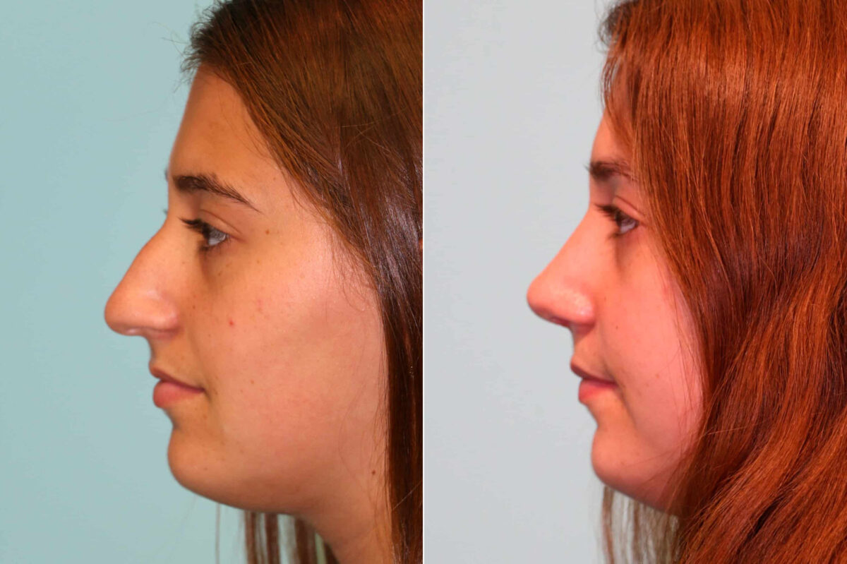 Before and after Rhinoplasty by Dr. Shervin Naderi, Patient 19253