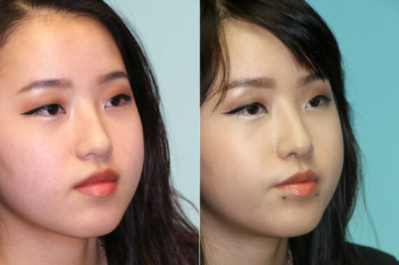 Before and after Rhinoplasty by Dr. Shervin Naderi, Patient 19339