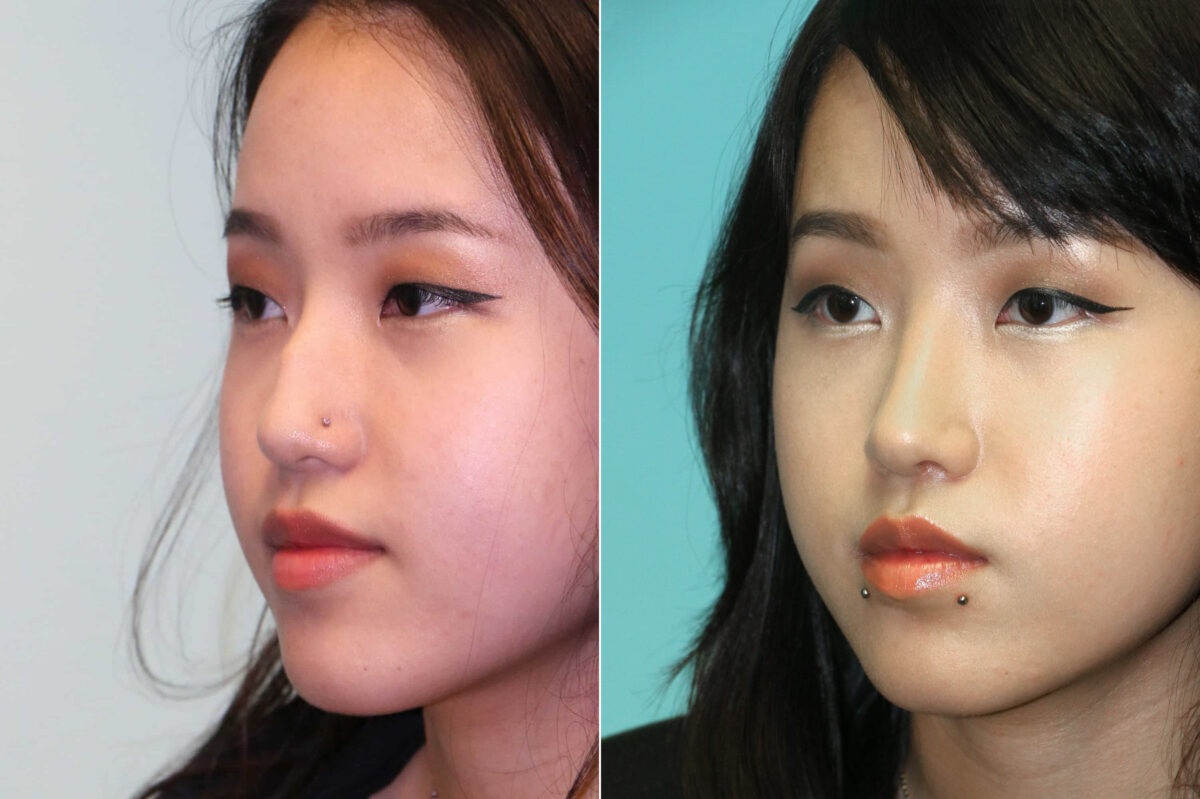 Before and after Rhinoplasty by Dr. Shervin Naderi, Patient 19339
