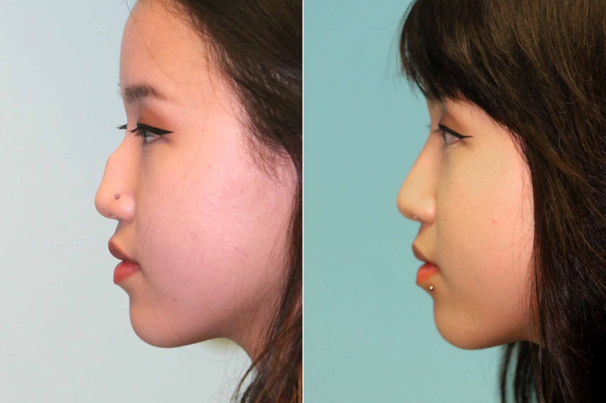 Before and after Rhinoplasty by Dr. Shervin Naderi, Patient 19339