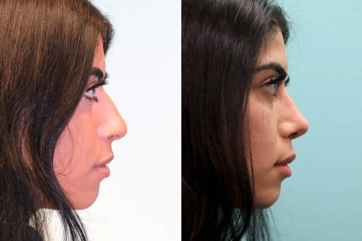 Before and after Rhinoplasty by Dr. Shervin Naderi, Patient 19358