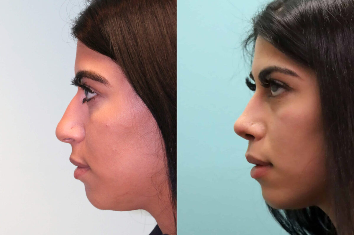 Before and after Rhinoplasty by Dr. Shervin Naderi, Patient 19358