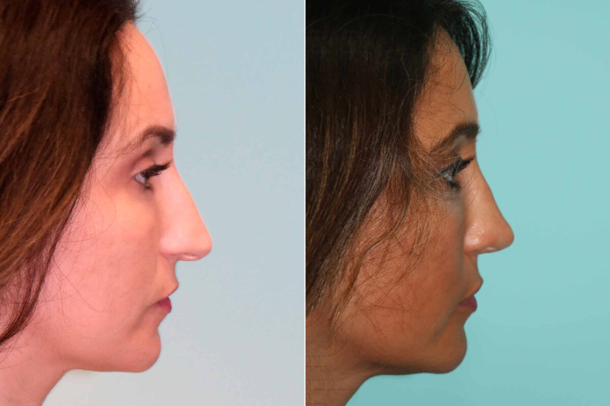 Before and after Rhinoplasty by Dr. Shervin Naderi, Patient 19506