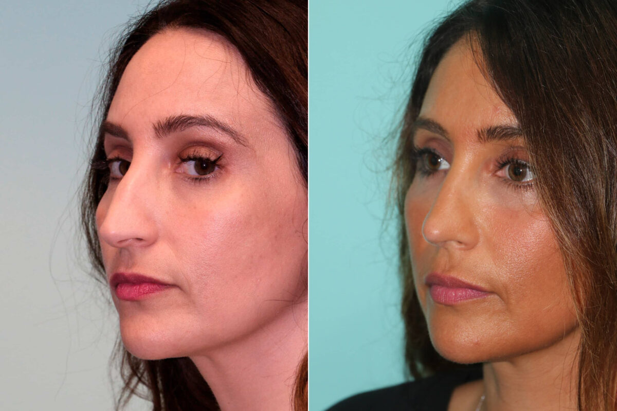 Before and after Rhinoplasty by Dr. Shervin Naderi, Patient 19506
