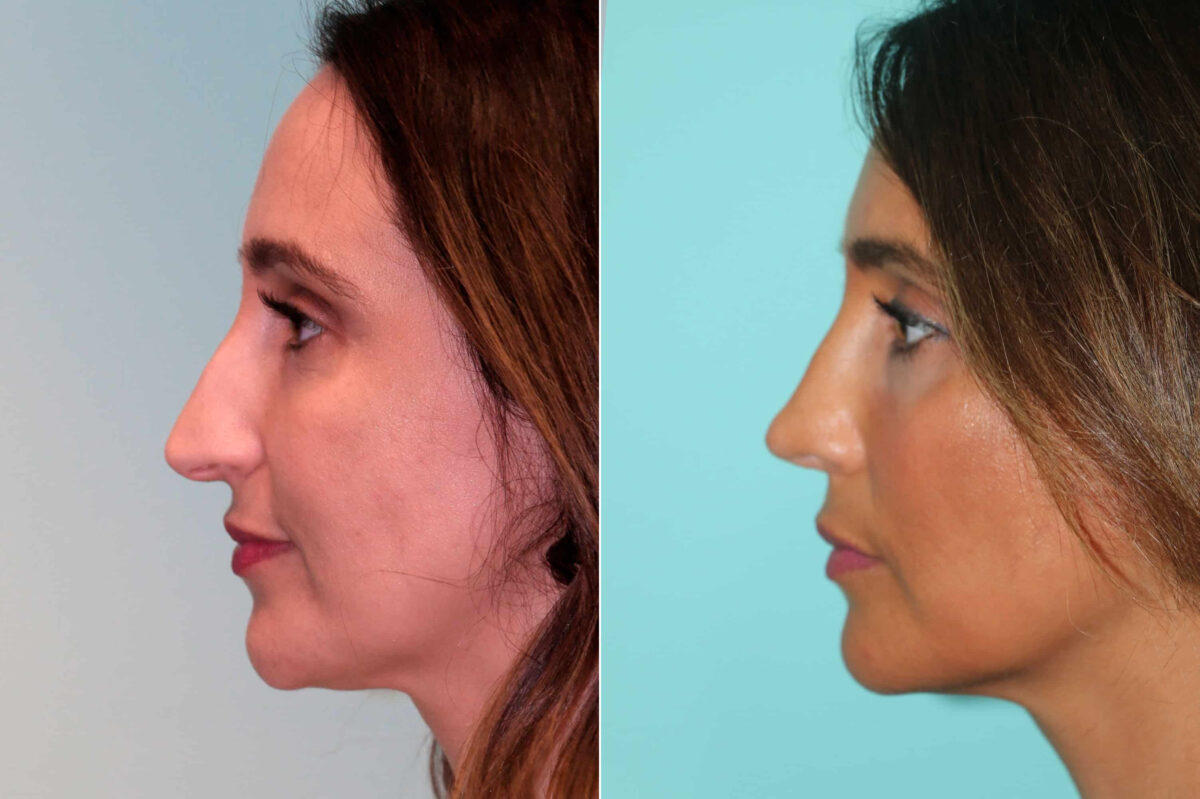 Before and after Rhinoplasty by Dr. Shervin Naderi, Patient 19506