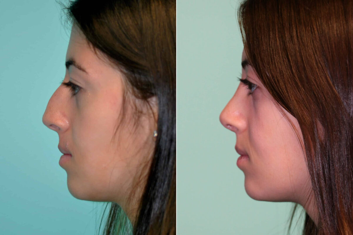 Before and after Rhinoplasty by Dr. Shervin Naderi, Patient 19522