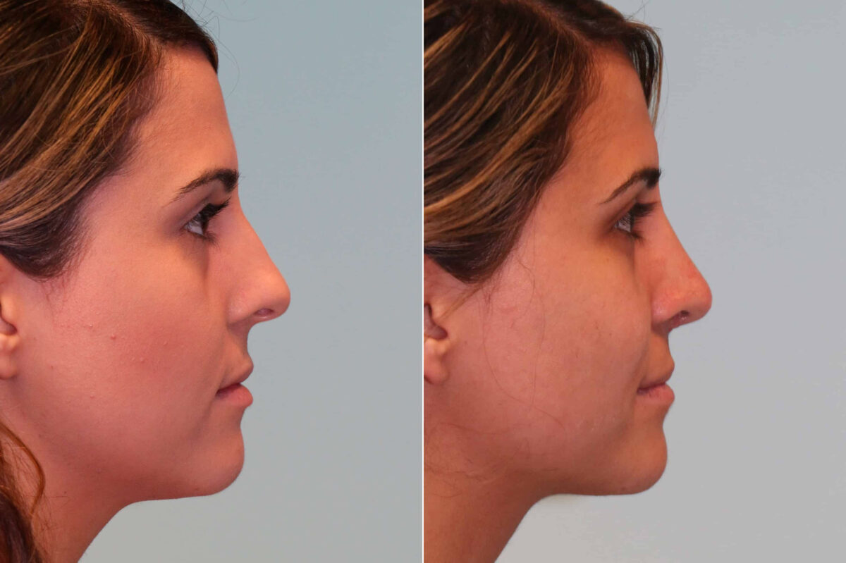 Before and after Rhinoplasty by Dr. Shervin Naderi, Patient 19565