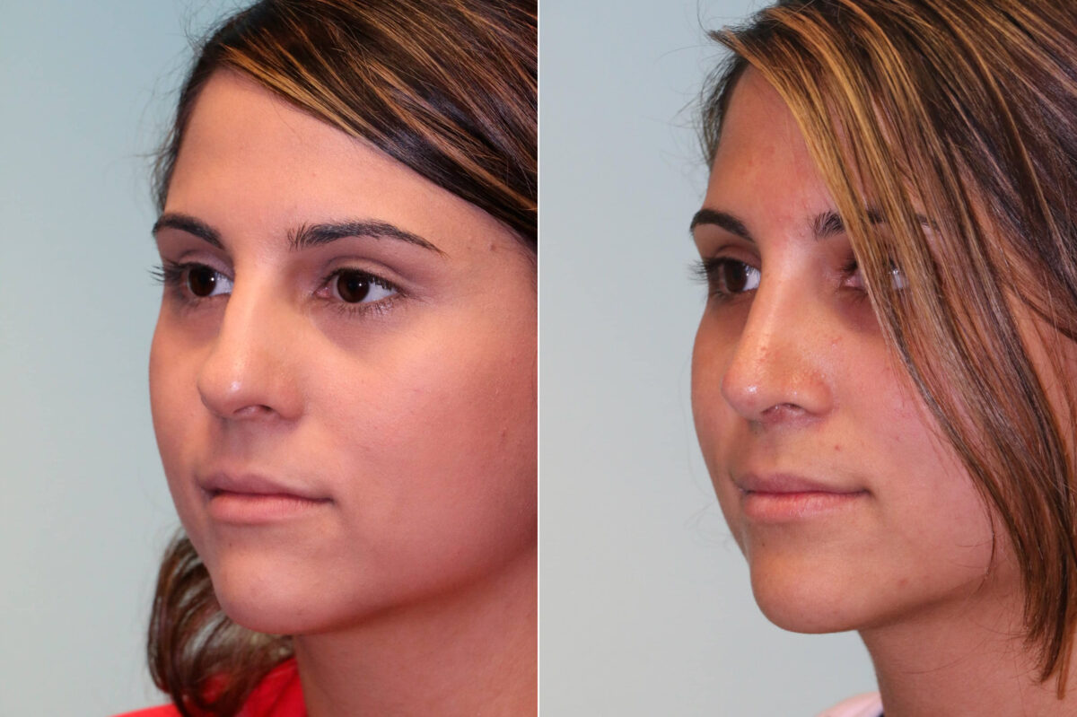 Before and after Rhinoplasty by Dr. Shervin Naderi, Patient 19565