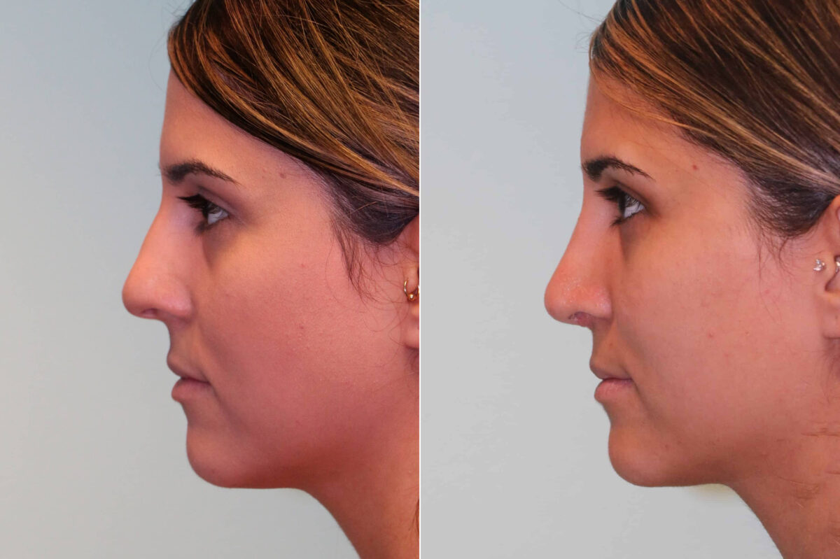 Before and after Rhinoplasty by Dr. Shervin Naderi, Patient 19565