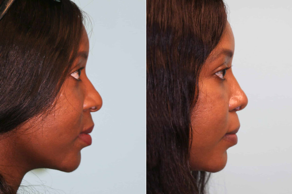 Before and after Rhinoplasty by Dr. Shervin Naderi, Patient 19710