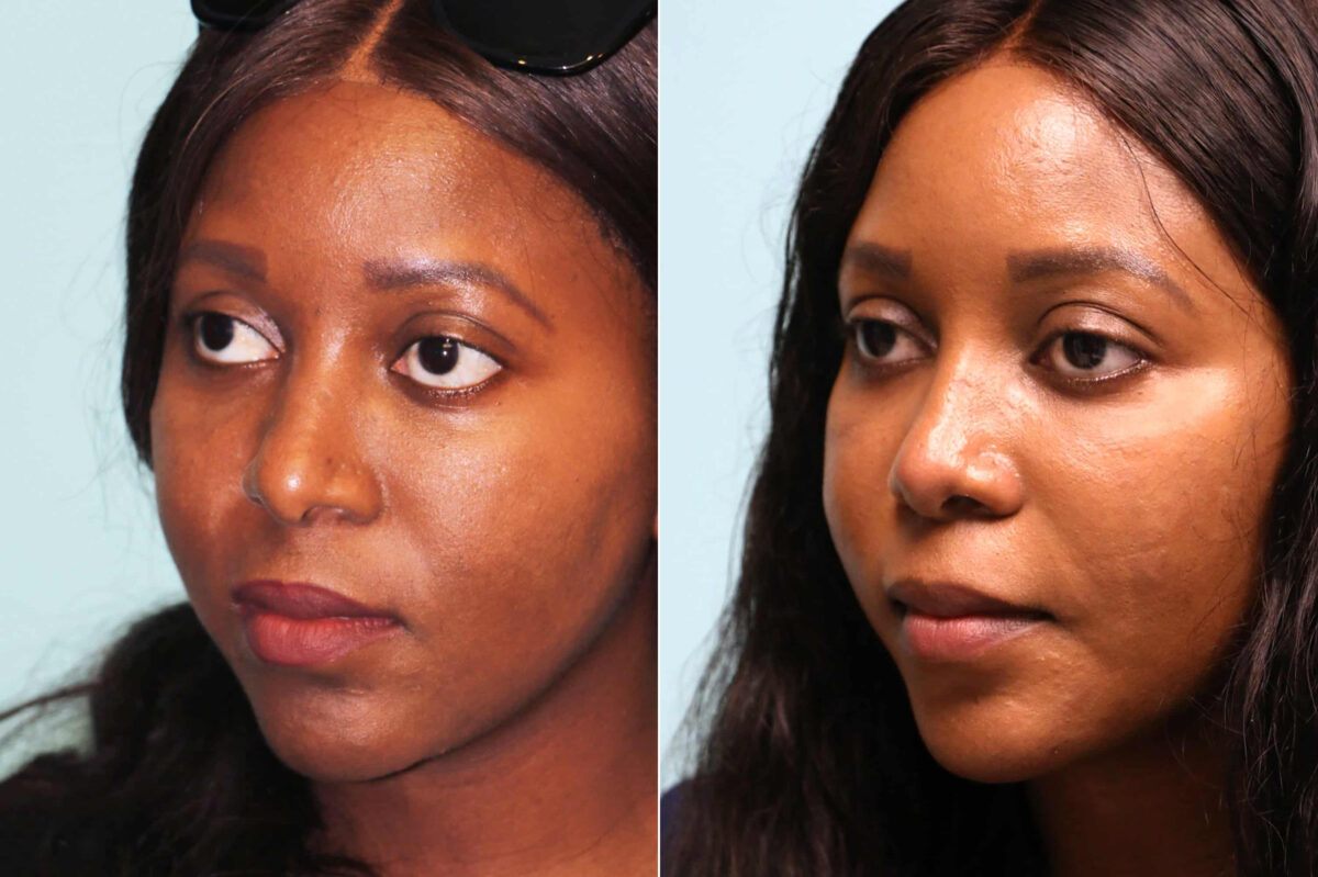Before and after Rhinoplasty by Dr. Shervin Naderi, Patient 19710