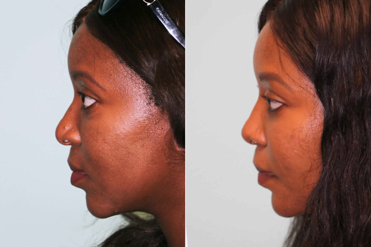 Before and after Rhinoplasty by Dr. Shervin Naderi, Patient 19710
