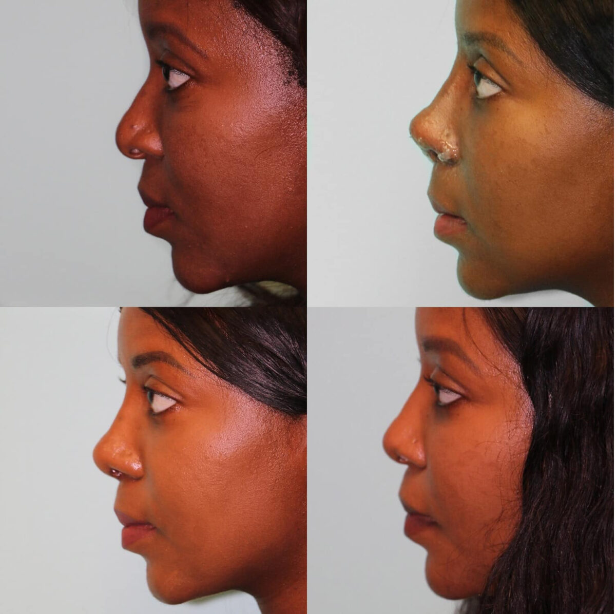 Before and after Rhinoplasty by Dr. Shervin Naderi, Patient 19710