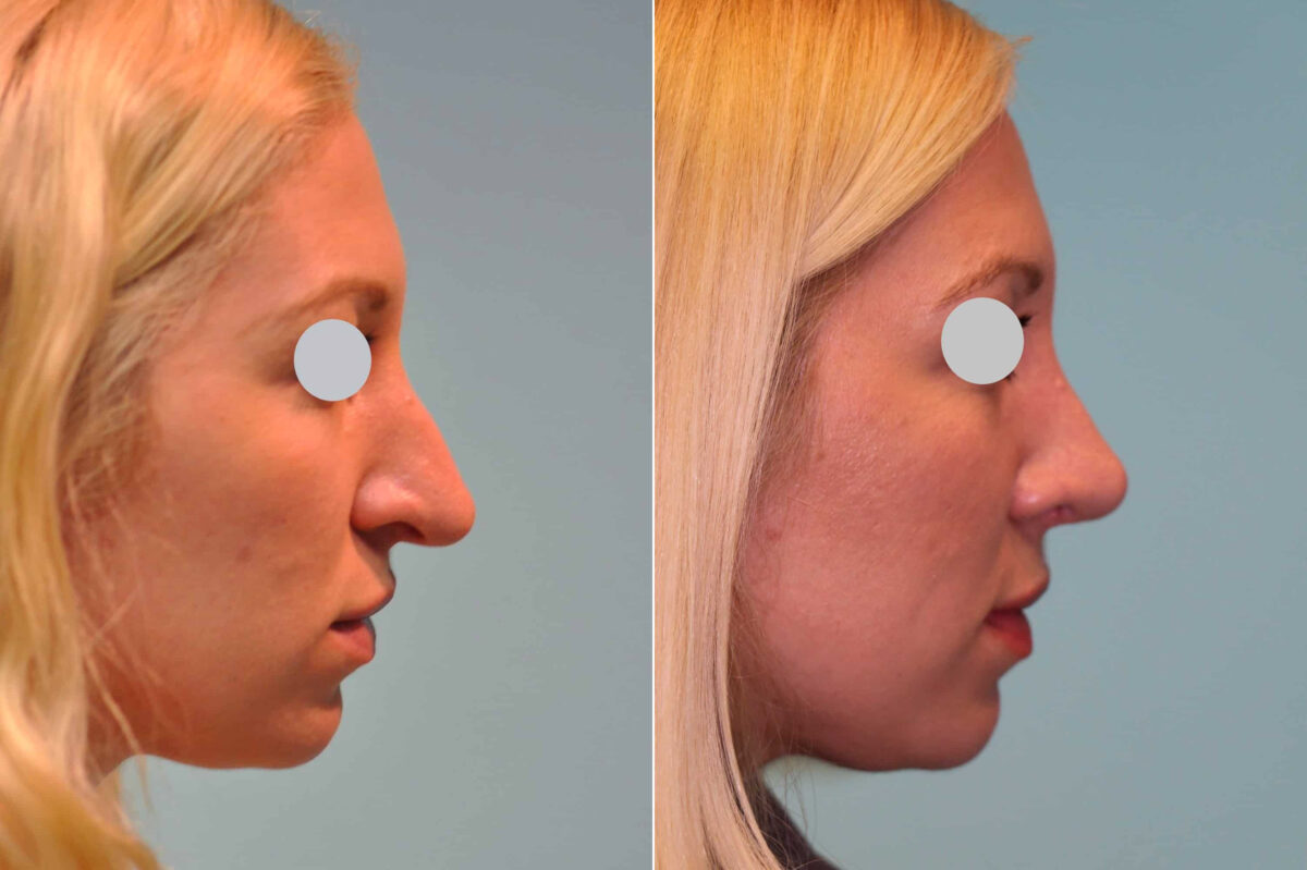 Before and after Revision Rhinoplasty by Dr. Shervin Naderi, Patient 19760