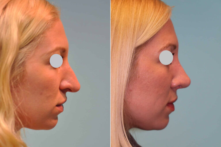 Before and after revision rhinoplasty by Dr. Shervin Naderi: a shorter, lifted tip