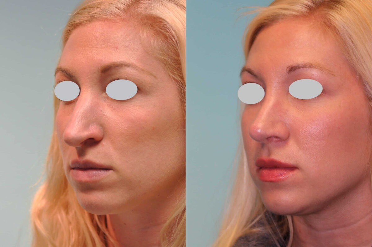 Before and after Revision Rhinoplasty by Dr. Shervin Naderi, Patient 19760