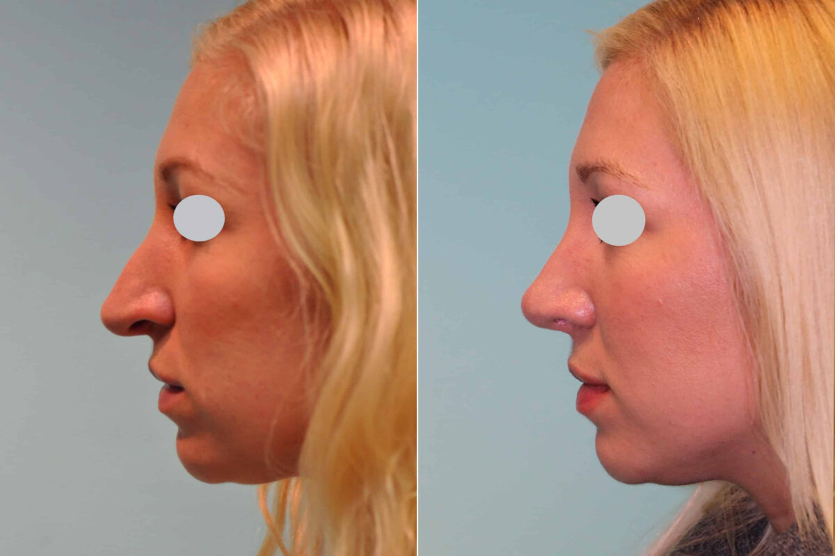 Before and after Revision Rhinoplasty by Dr. Shervin Naderi, Patient 19760