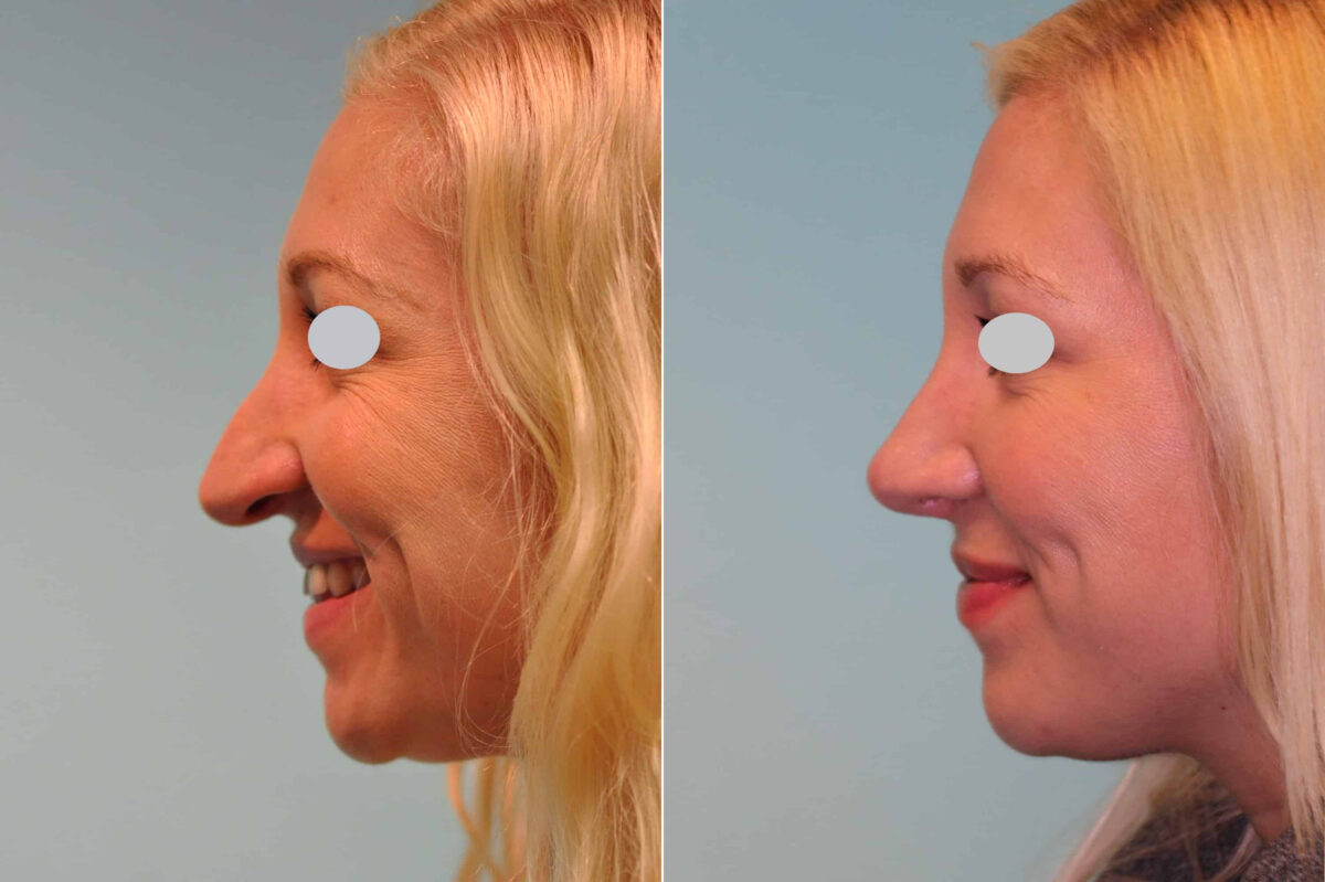 Before and after Revision Rhinoplasty by Dr. Shervin Naderi, Patient 19760