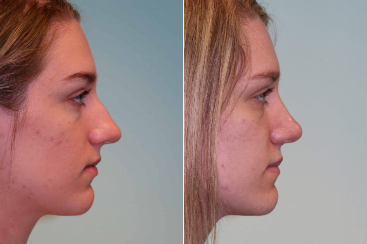 Before and after Rhinoplasty by Dr. Shervin Naderi, Patient 19807