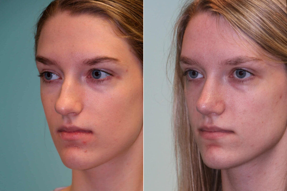 Before and after Rhinoplasty by Dr. Shervin Naderi, Patient 19807