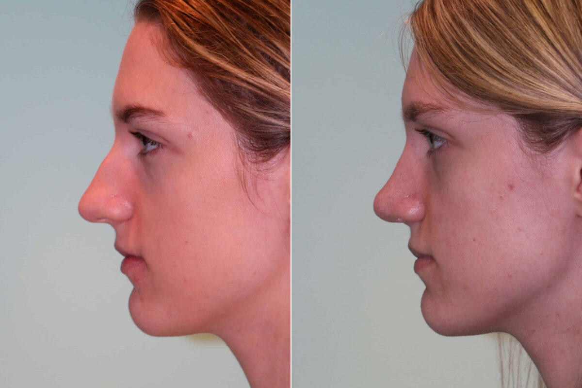 Before and after Rhinoplasty by Dr. Shervin Naderi, Patient 19807