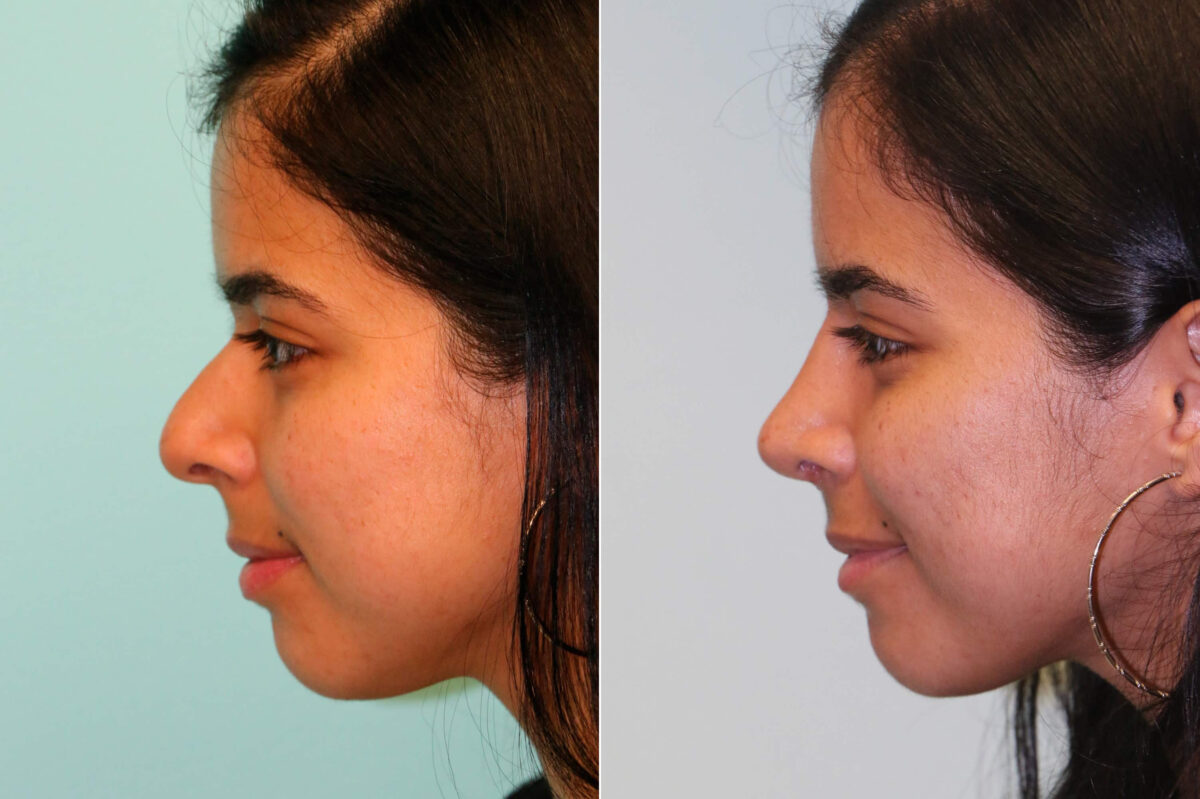 Before and after Rhinoplasty by Dr. Shervin Naderi, Patient 19826