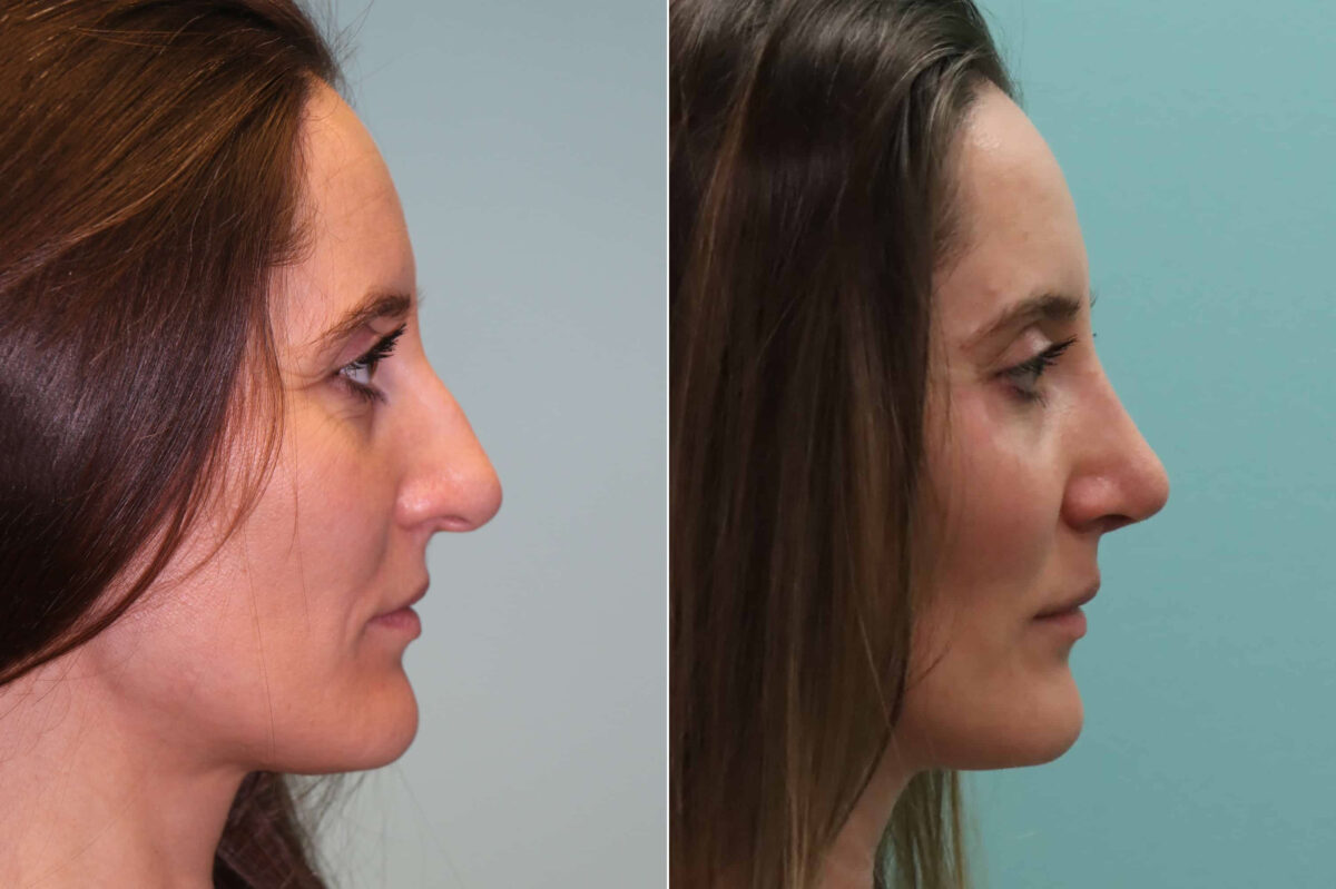Before and after Rhinoplasty by Dr. Shervin Naderi, Patient 19975