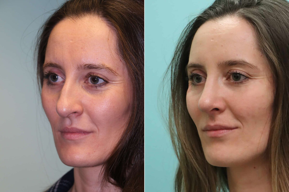 Before and after Rhinoplasty by Dr. Shervin Naderi, Patient 19975