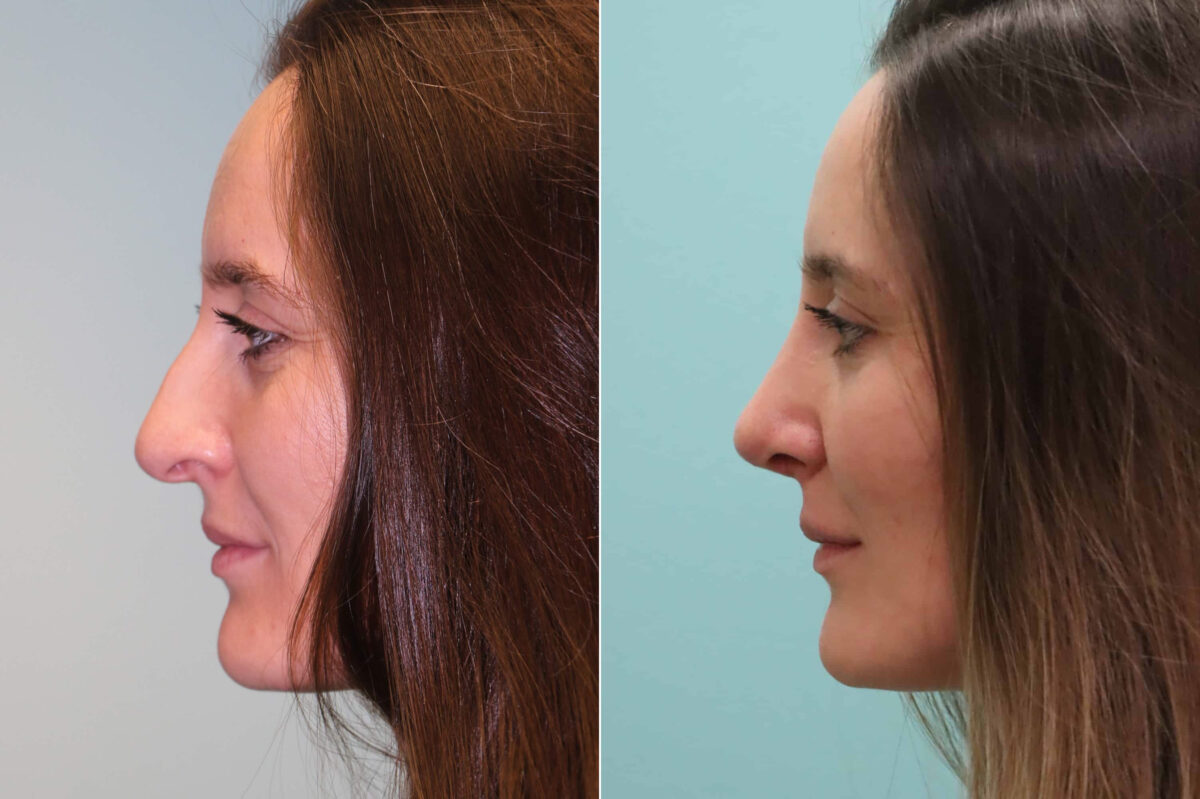 Before and after Rhinoplasty by Dr. Shervin Naderi, Patient 19975