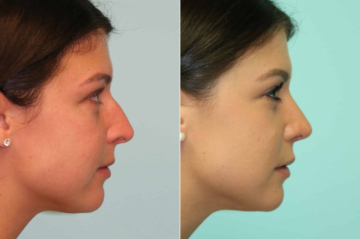 Before and after Rhinoplasty by Dr. Shervin Naderi, Patient 20218