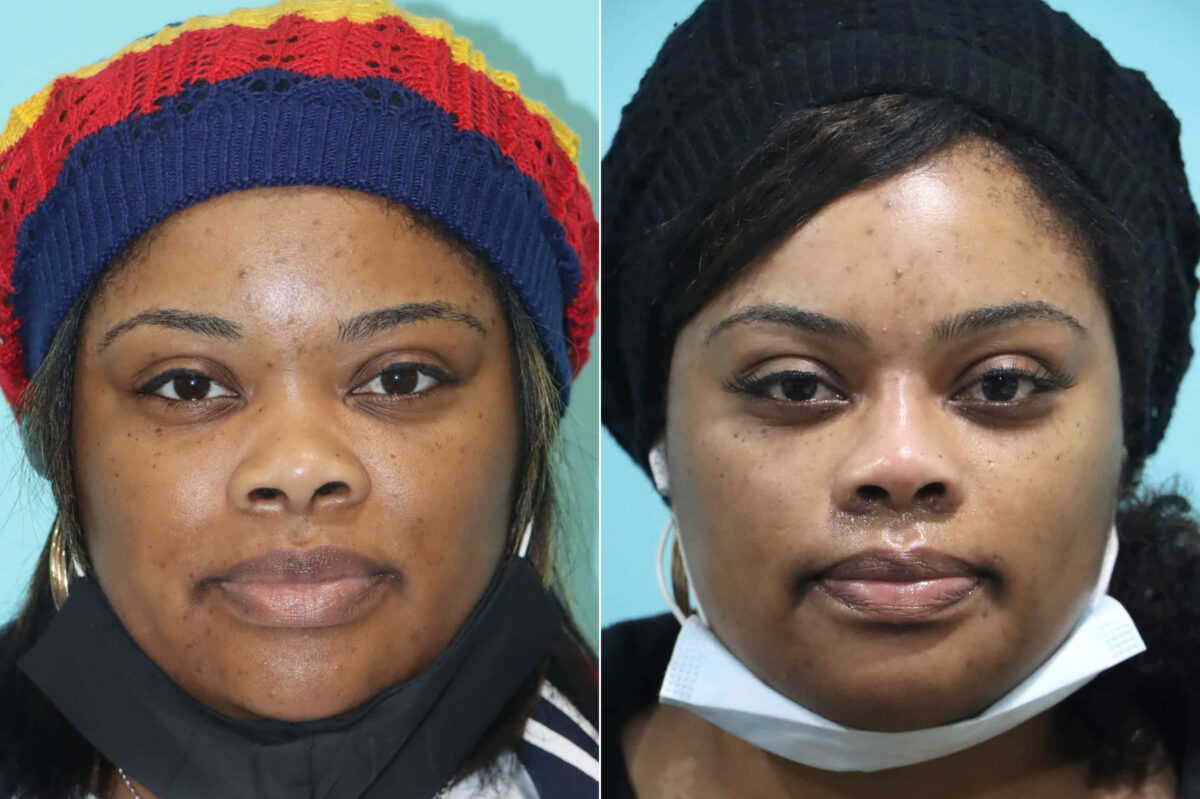 Before and after Non-Surgical Rhinoplasty by Dr. Shervin Naderi, Patient 21139