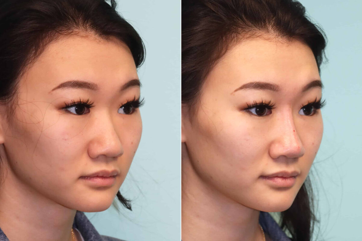 Before and after Non-Surgical Rhinoplasty by Dr. Shervin Naderi, Patient 21448