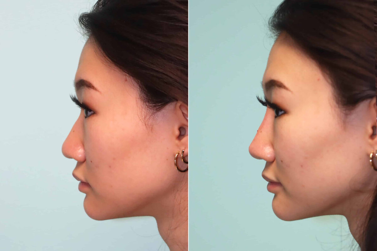 Before and after Non-Surgical Rhinoplasty by Dr. Shervin Naderi, Patient 21448