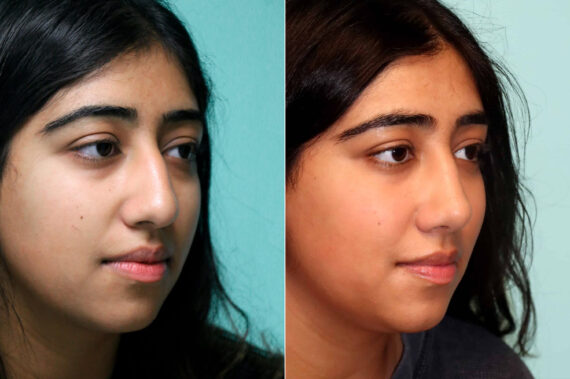 Before and after Rhinoplasty by Dr. Shervin Naderi, Patient 21483