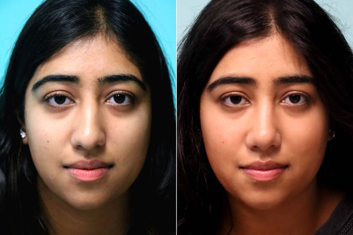Before and after Rhinoplasty by Dr. Shervin Naderi, Patient 21483