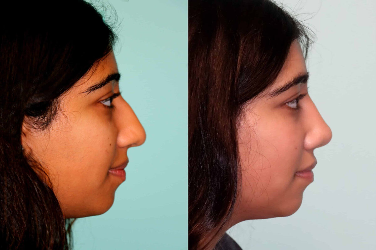 Before and after Rhinoplasty by Dr. Shervin Naderi, Patient 21483