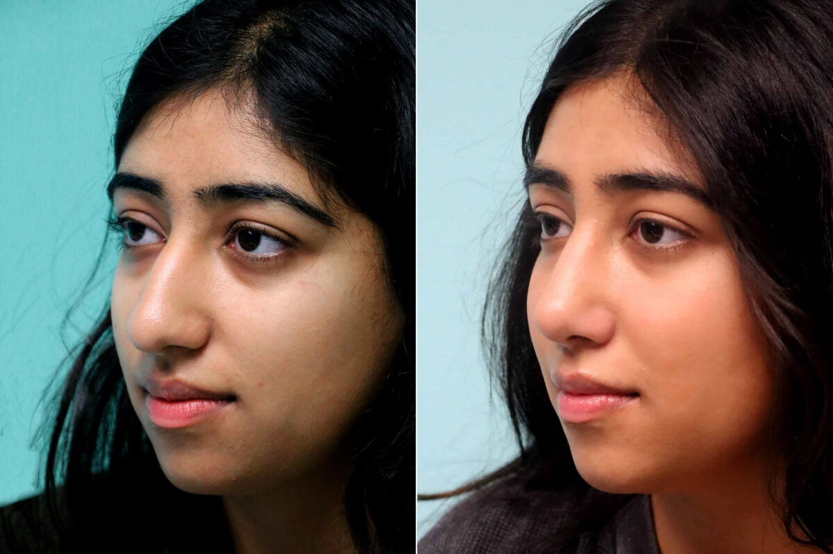 Before and after Rhinoplasty by Dr. Shervin Naderi, Patient 21483