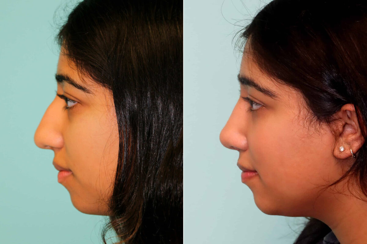 Before and after Rhinoplasty by Dr. Shervin Naderi, Patient 21483