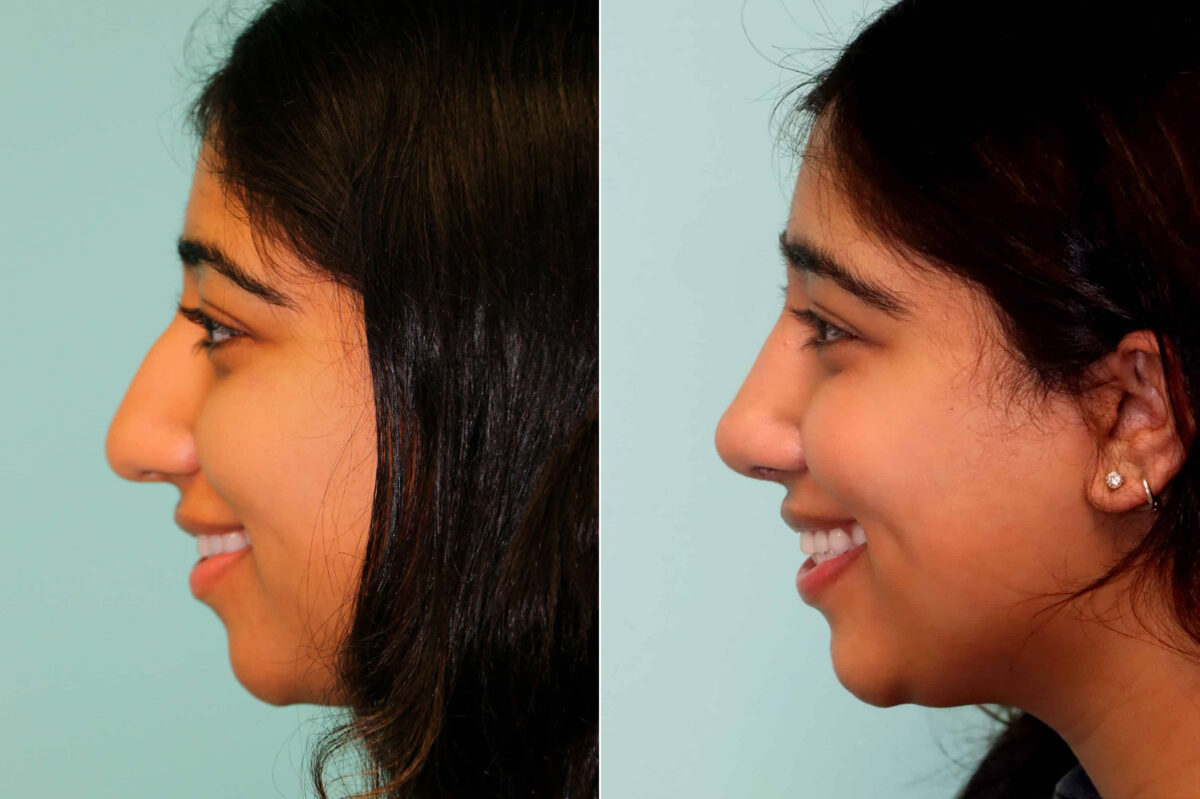 Before and after Rhinoplasty by Dr. Shervin Naderi, Patient 21483