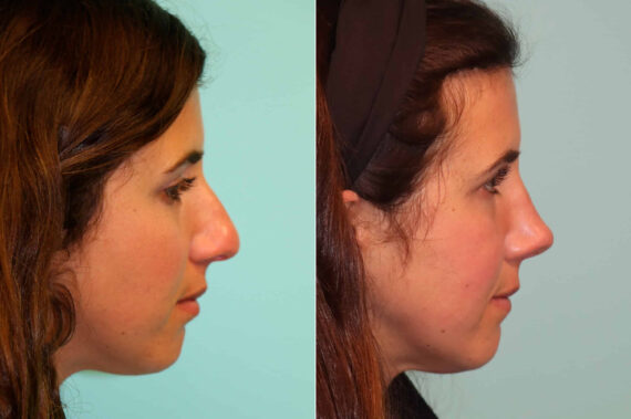Before and after Rhinoplasty by Dr. Shervin Naderi, Patient 21551