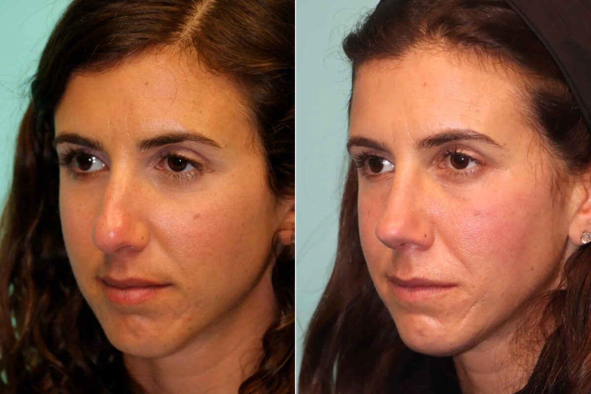 Before and after Rhinoplasty by Dr. Shervin Naderi, Patient 21551