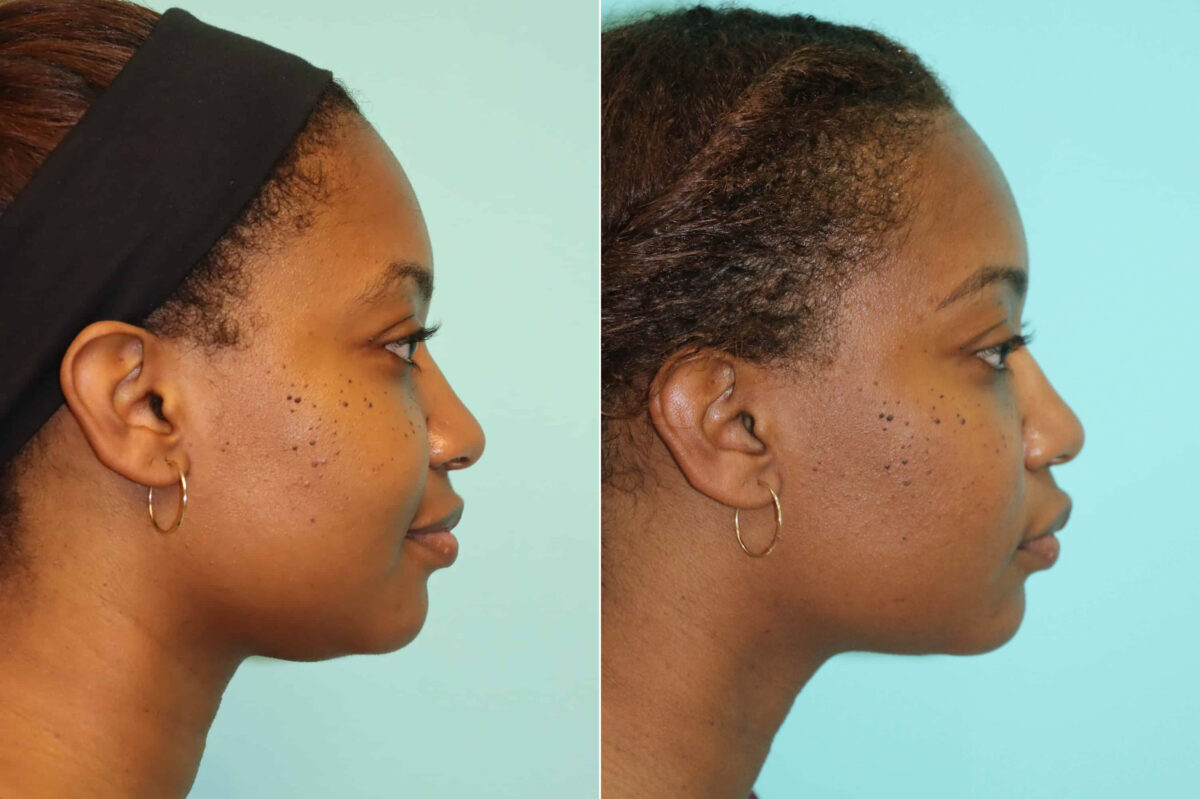 Before and after KYBELLA by Dr. Shervin Naderi, Patient 22112