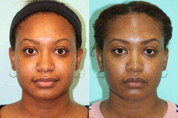 Before and after KYBELLA by Dr. Shervin Naderi, Patient 22112