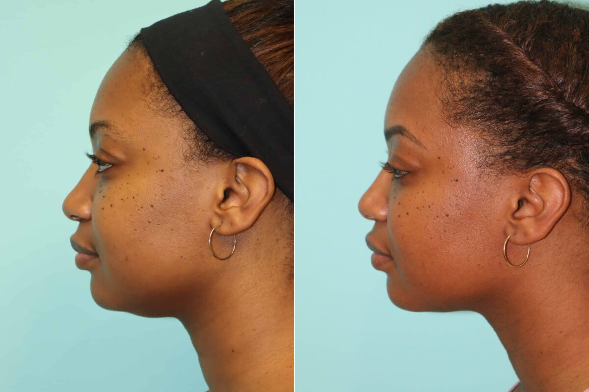 Before and after KYBELLA by Dr. Shervin Naderi, Patient 22112