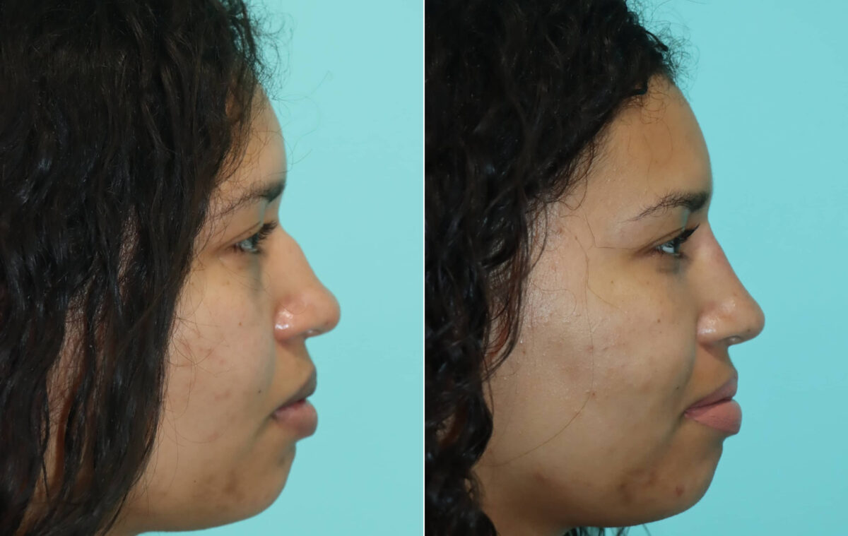 Before and after Non-Surgical Rhinoplasty by Dr. Shervin Naderi, Patient 22391