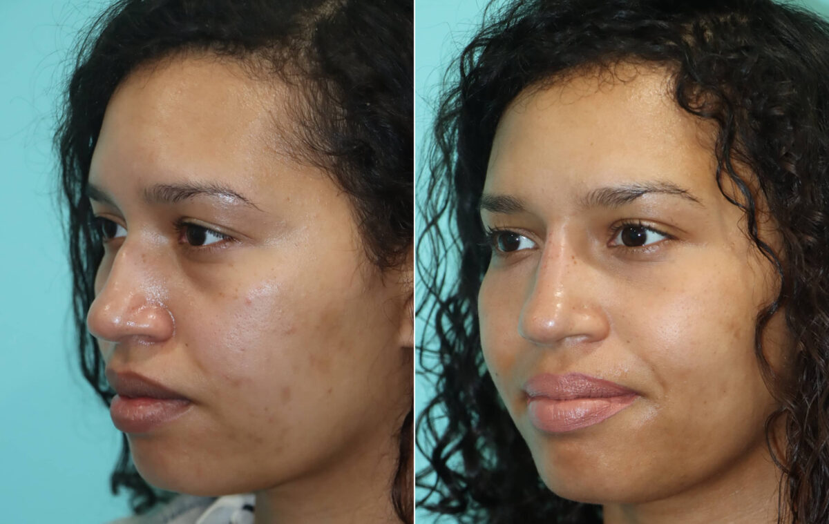 Before and after Non-Surgical Rhinoplasty by Dr. Shervin Naderi, Patient 22391