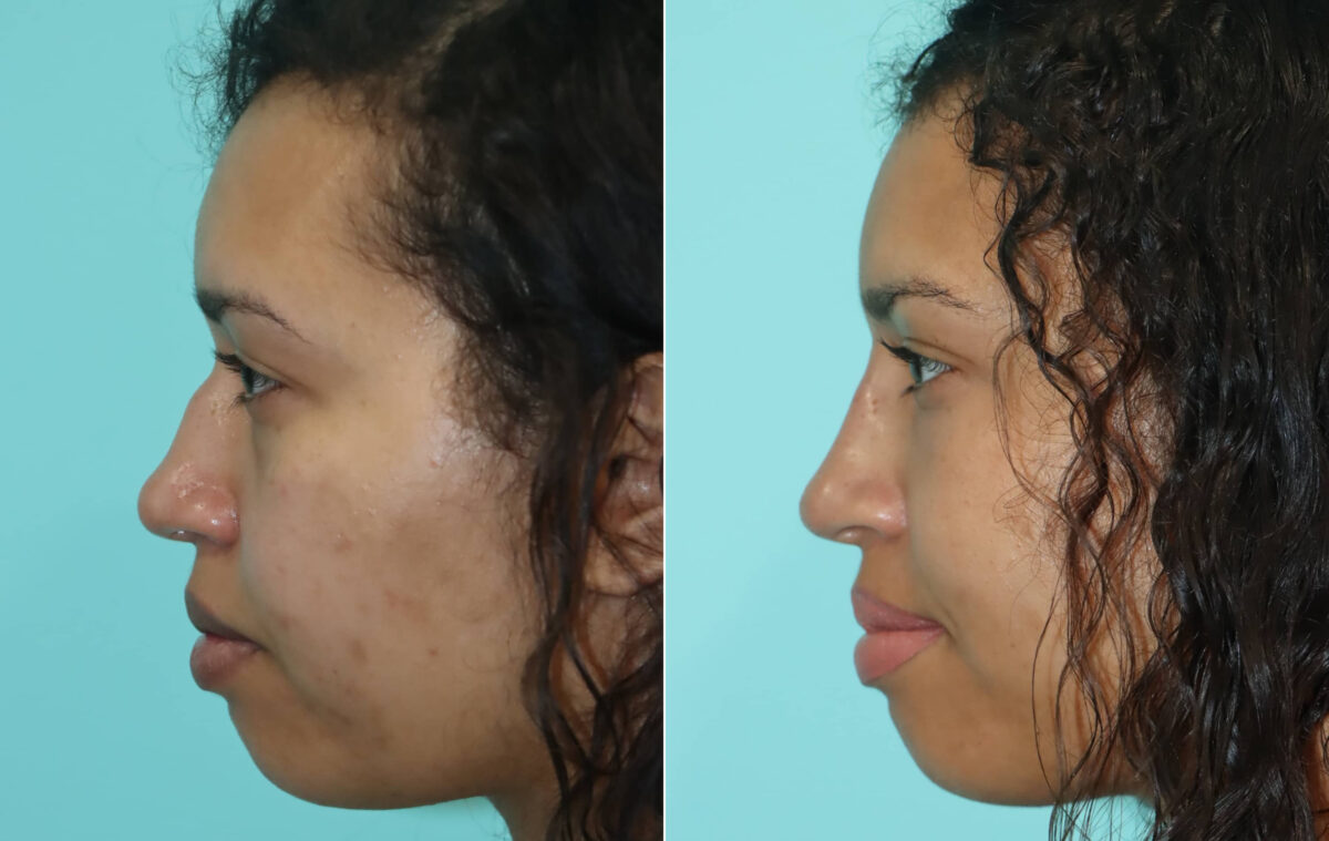 Before and after Non-Surgical Rhinoplasty by Dr. Shervin Naderi, Patient 22391